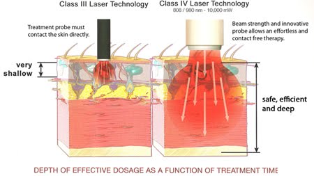 lasertherapie apparatuur